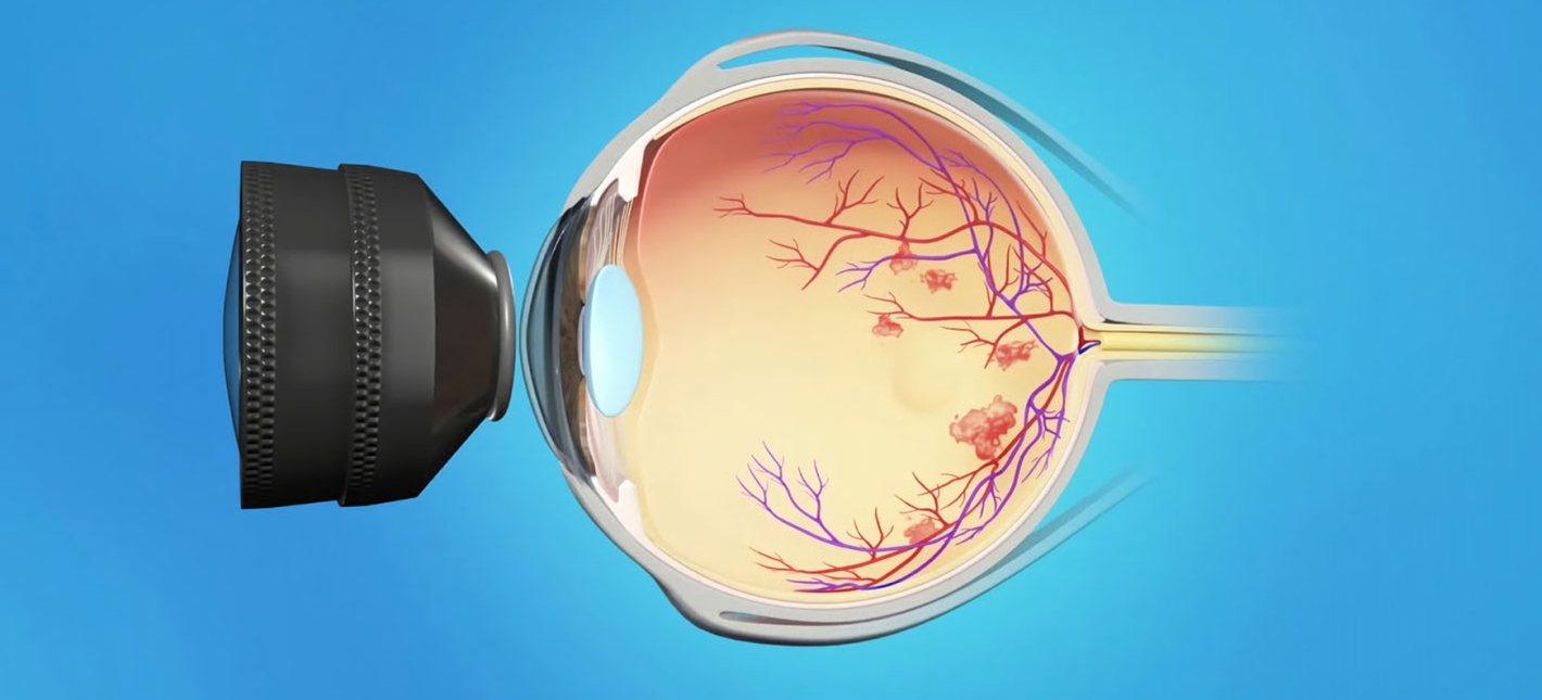 Лазерная коагуляция сетчатки глаза 
