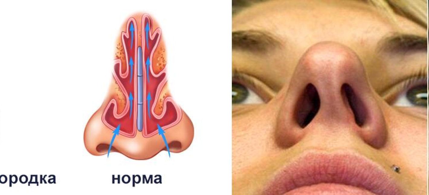 Септумпластика, септумпластика с эндоскопическим контролем
