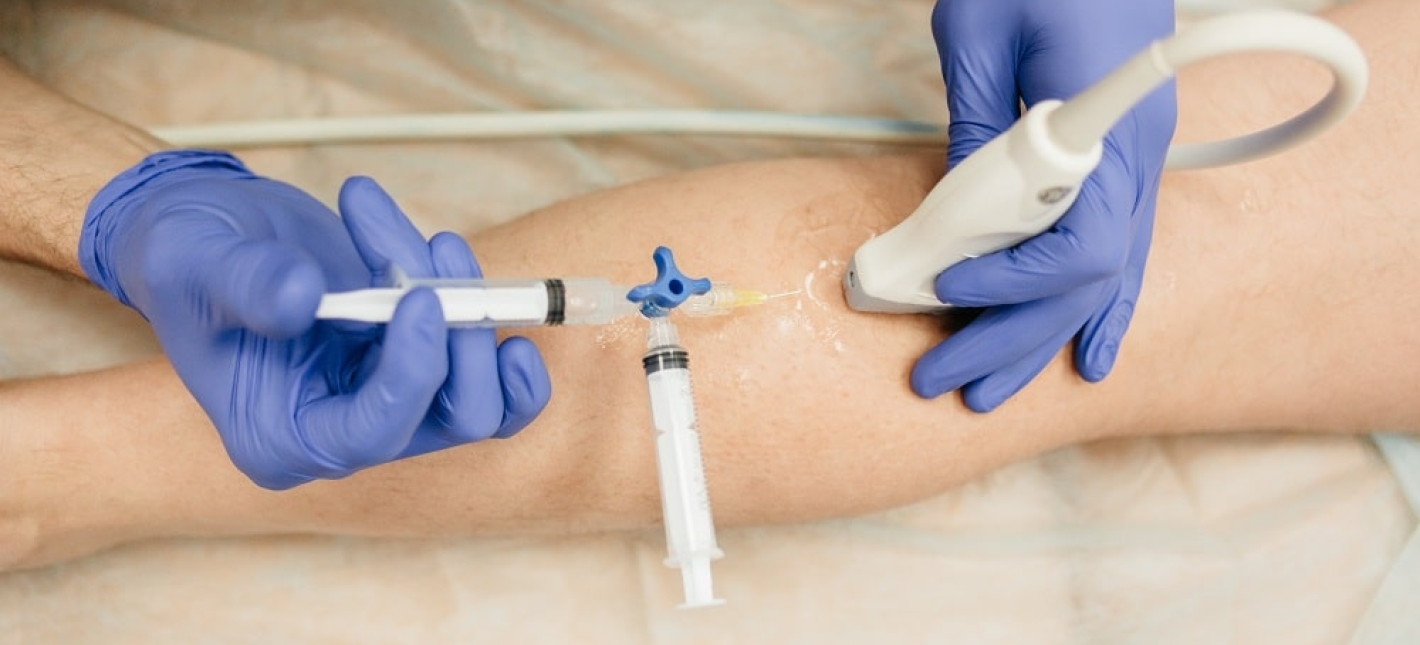 Склеротерапия