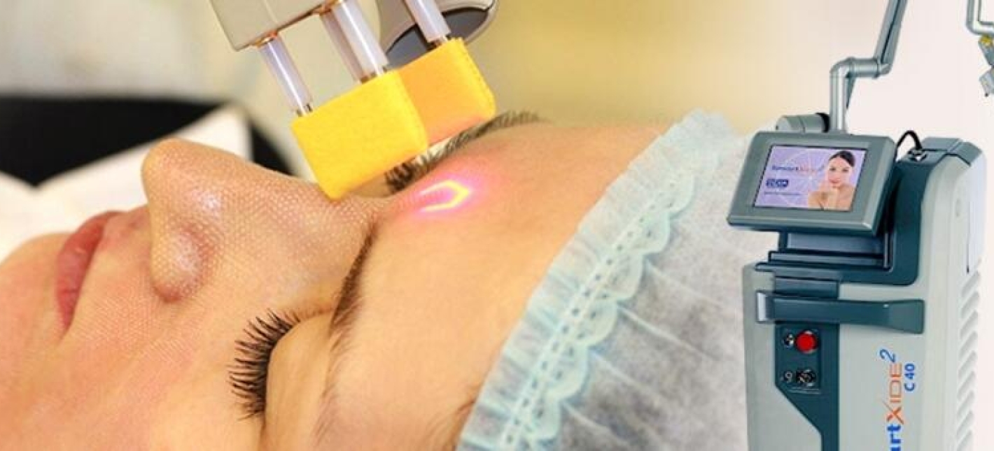 Лазерная шлифовка кожи (СО² лазер) — коррекция возрастных изменений, лечение рубцов постакне, коррекция растяжек, рубцов