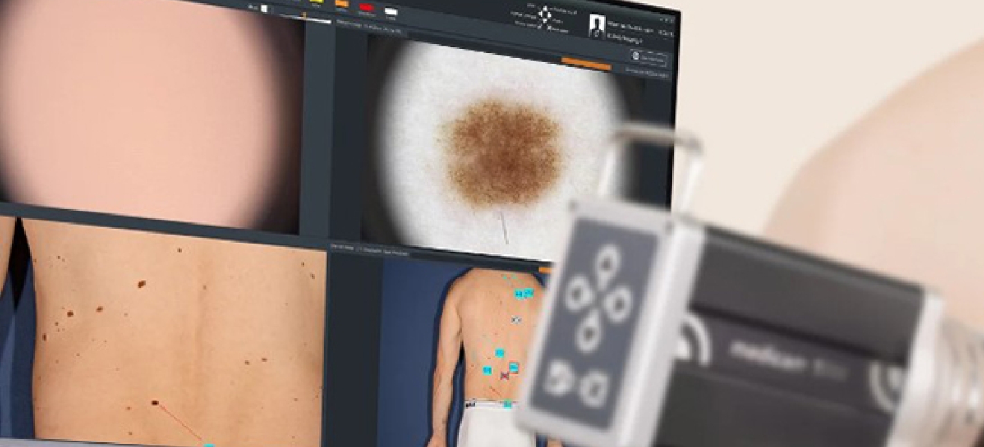 Компьютерная дерматоскопия (за 1 новообразование)