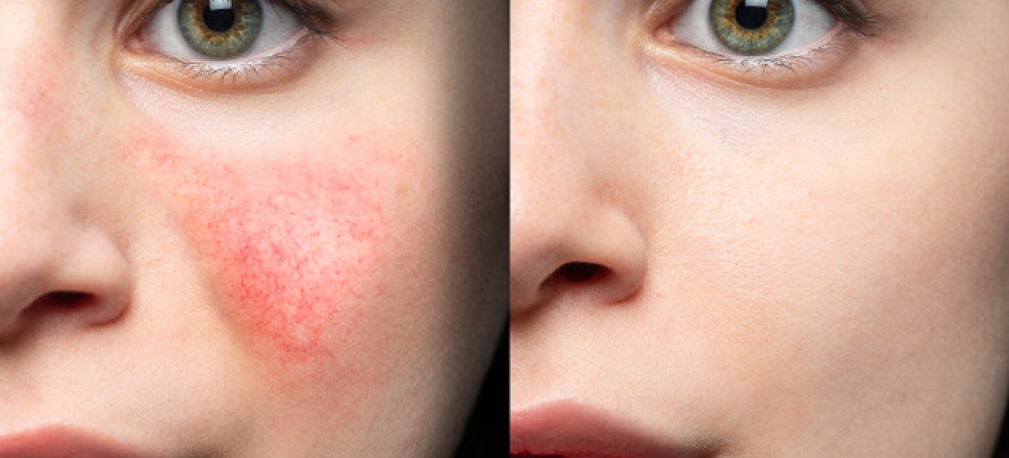 Фотолечение сосудистых патологий (купероза, розацеа)